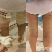 共振吸脂抽脂多少钱？有什么风险吗？