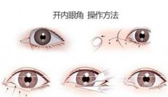 成都韩式微创开眼角多少钱?