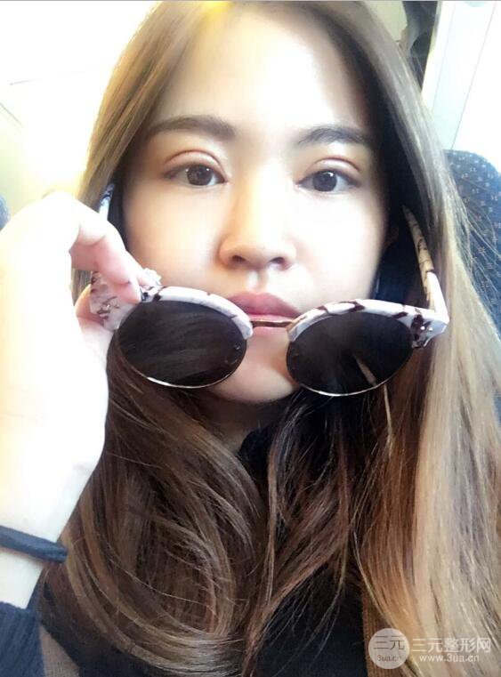 沈阳百嘉丽叶微微切开双眼皮前后对比图恢复心情小札