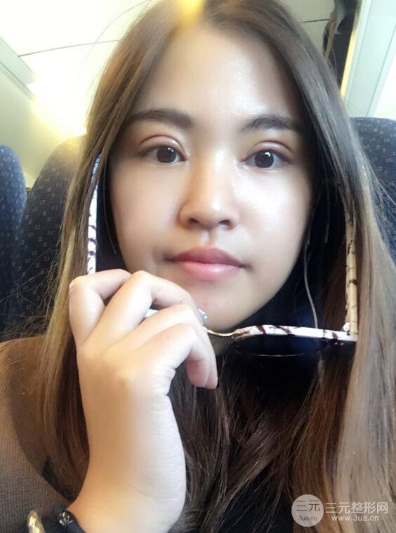 沈阳百嘉丽叶微微切开双眼皮前后对比图恢复心情小札