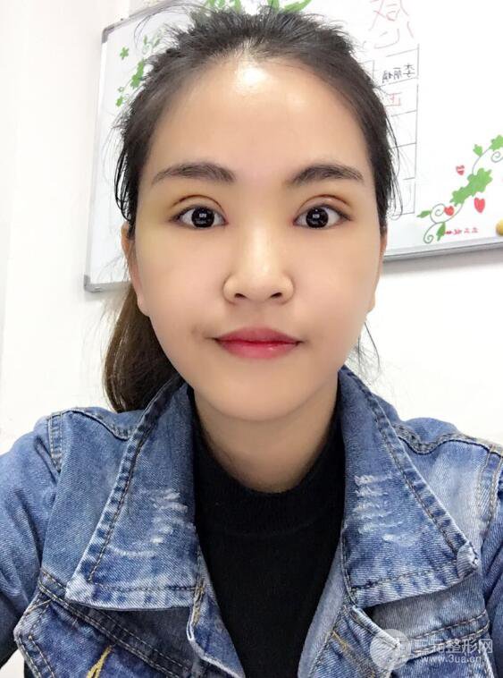 沈阳百嘉丽叶微微切开双眼皮前后对比图恢复心情小札