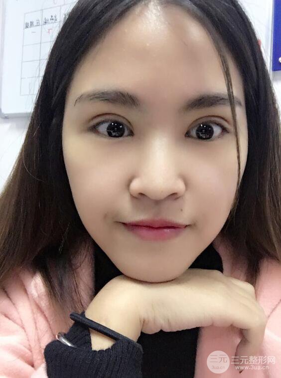 沈阳百嘉丽叶微微切开双眼皮前后对比图恢复心情小札