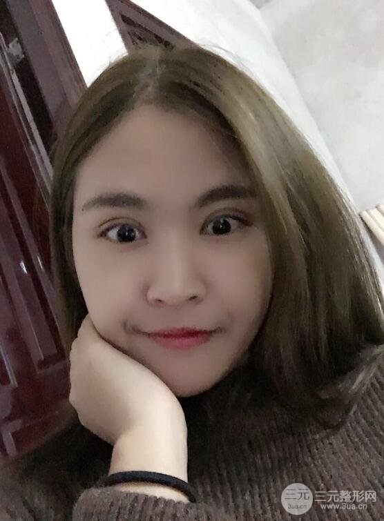 沈阳百嘉丽叶微微切开双眼皮前后对比图恢复心情小札