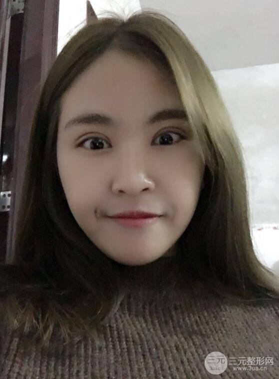 沈阳百嘉丽叶微微切开双眼皮前后对比图恢复心情小札