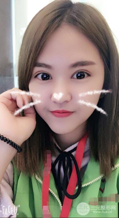 沈阳百嘉丽叶微微切开双眼皮前后对比图恢复心情小札