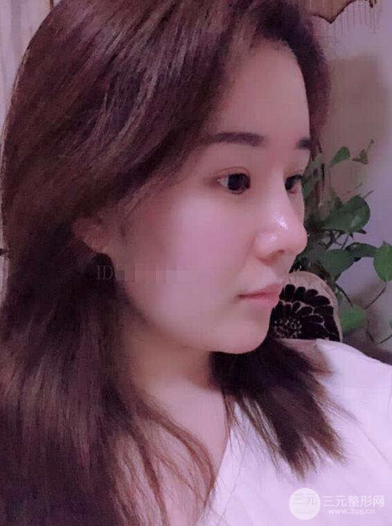 上海华美李庭勋膨体隆鼻前后对比图一个月恢复心情日记