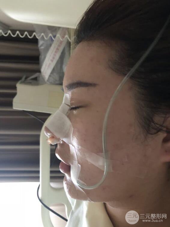 上海华美李庭勋膨体隆鼻前后对比图一个月恢复心情日记