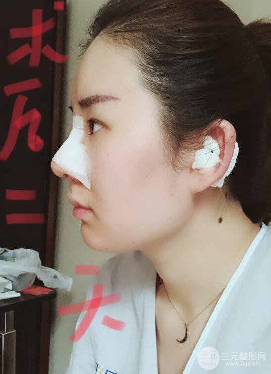 上海华美李庭勋膨体隆鼻前后对比图一个月恢复心情日记