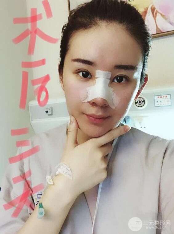 上海华美李庭勋膨体隆鼻前后对比图一个月恢复心情日记