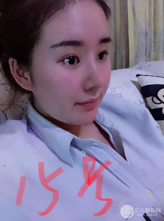 上海华美李庭勋膨体隆鼻前后对比图一个月恢复心情日记