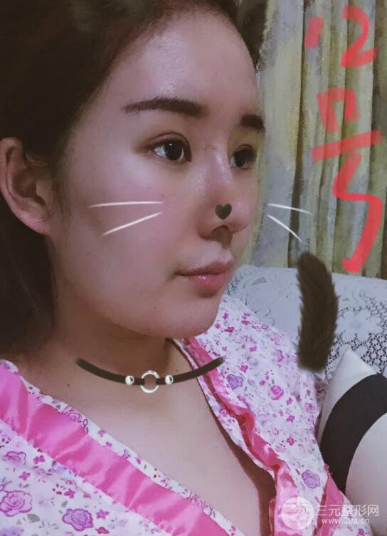 上海华美李庭勋膨体隆鼻前后对比图一个月恢复心情日记