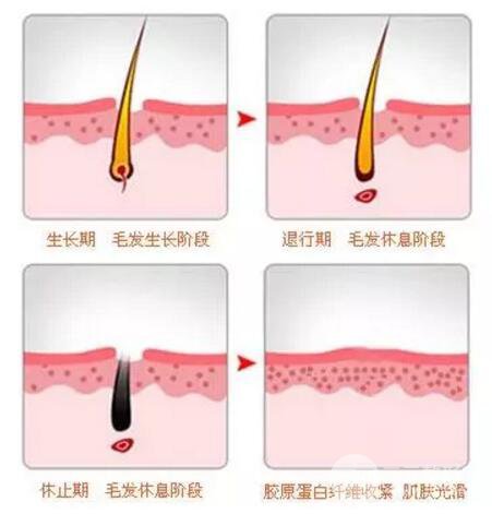 武汉激光脱毛多少钱呢，激光脱毛果好不好了