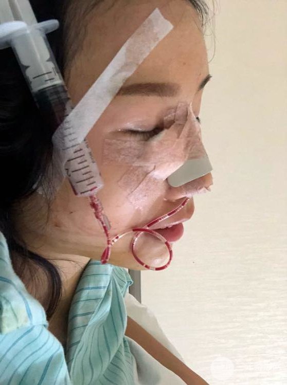 昆明华美美莱杨继红肋软骨隆鼻前后对比图恢复手札