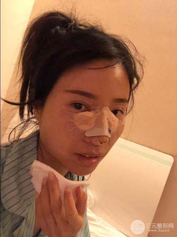 昆明华美美莱杨继红肋软骨隆鼻前后对比图恢复手札