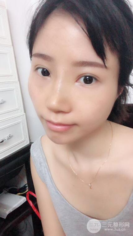 昆明华美美莱杨继红肋软骨隆鼻前后对比图恢复手札