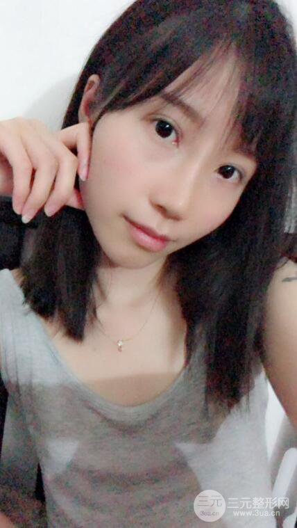 昆明华美美莱杨继红肋软骨隆鼻前后对比图恢复手札