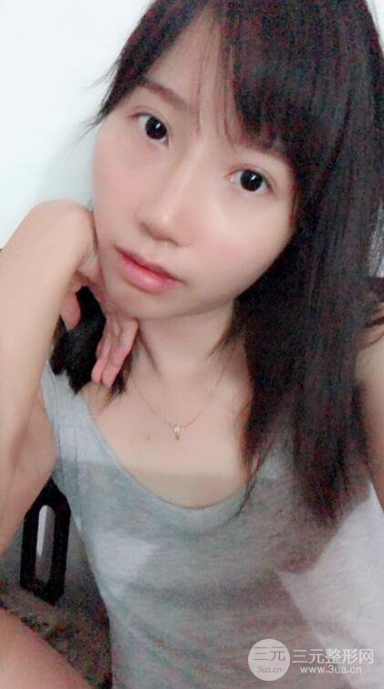 昆明华美美莱杨继红肋软骨隆鼻前后对比图恢复手札