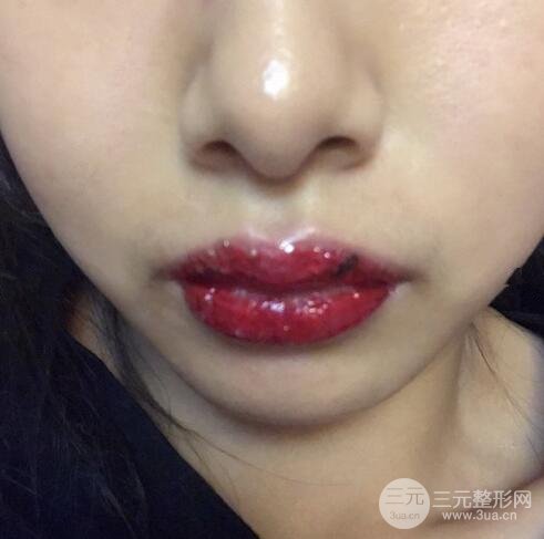 漂唇后多久能恢复正常?