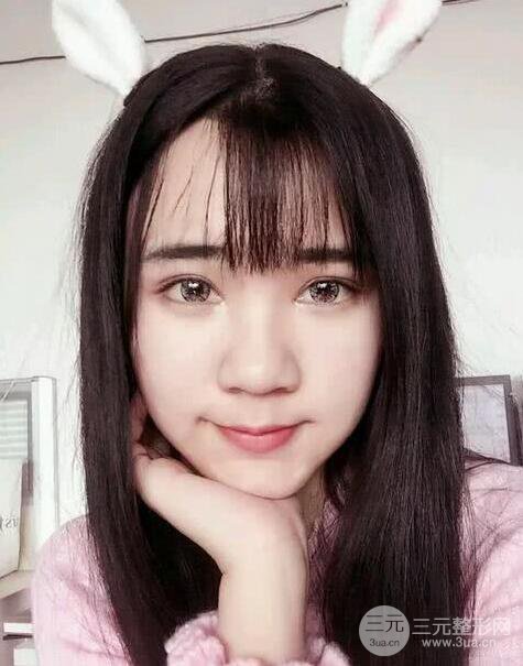青医附院美容科任纪祯塌鼻子隆鼻前后对比图恢复心情小札