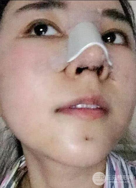 青医附院美容科任纪祯塌鼻子隆鼻前后对比图恢复心情小札