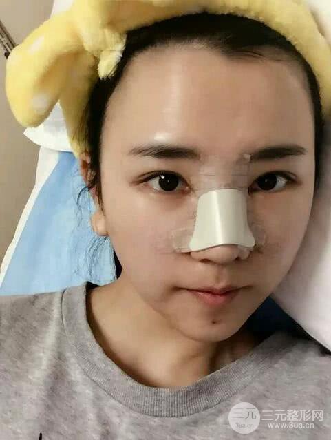 青医附院美容科任纪祯塌鼻子隆鼻前后对比图恢复心情小札