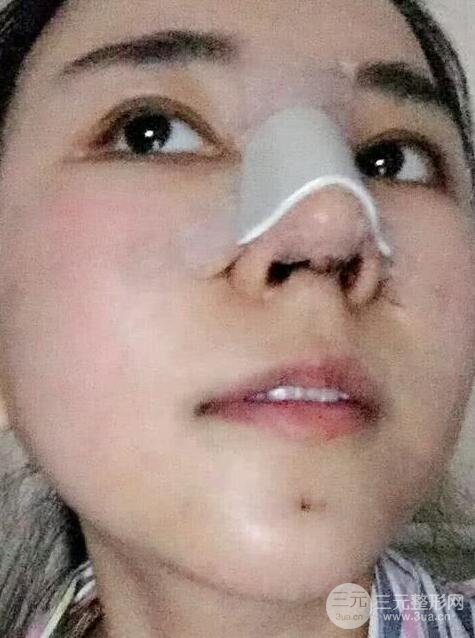 青医附院美容科任纪祯塌鼻子隆鼻前后对比图恢复心情小札