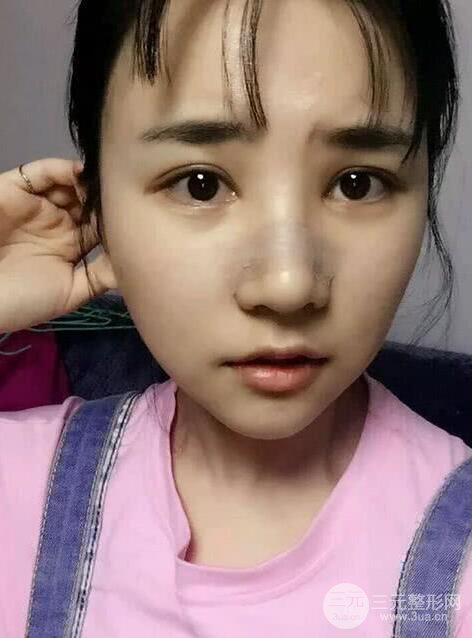 青医附院美容科任纪祯塌鼻子隆鼻前后对比图恢复心情小札
