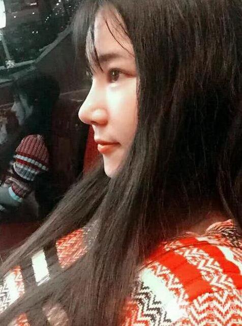 青医附院美容科任纪祯塌鼻子隆鼻前后对比图恢复心情小札
