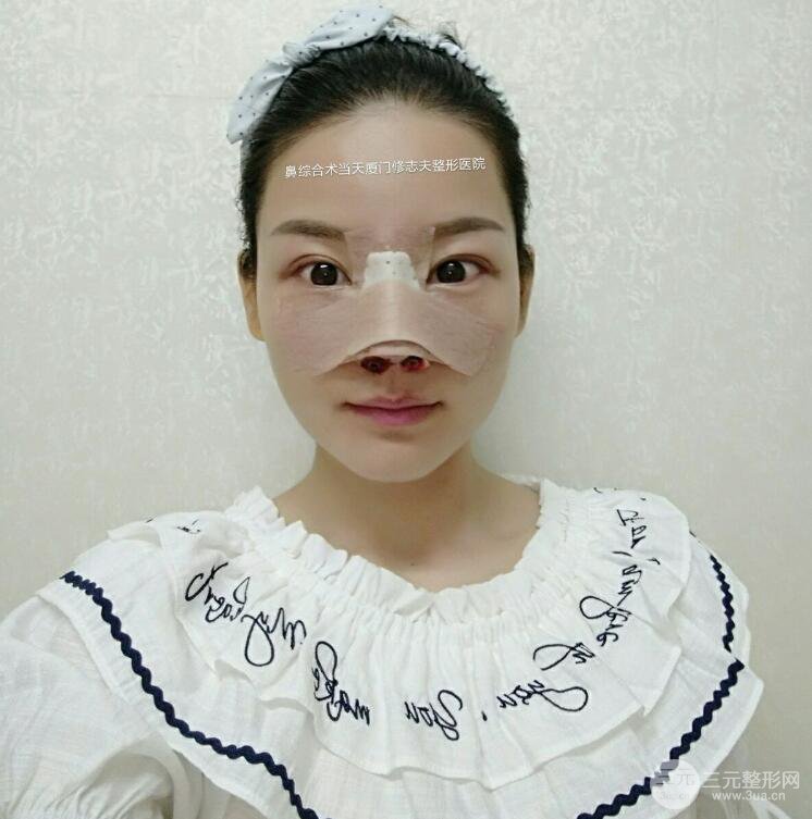 厦门修志夫隆鼻整形前后对比图真人案例恢复小札