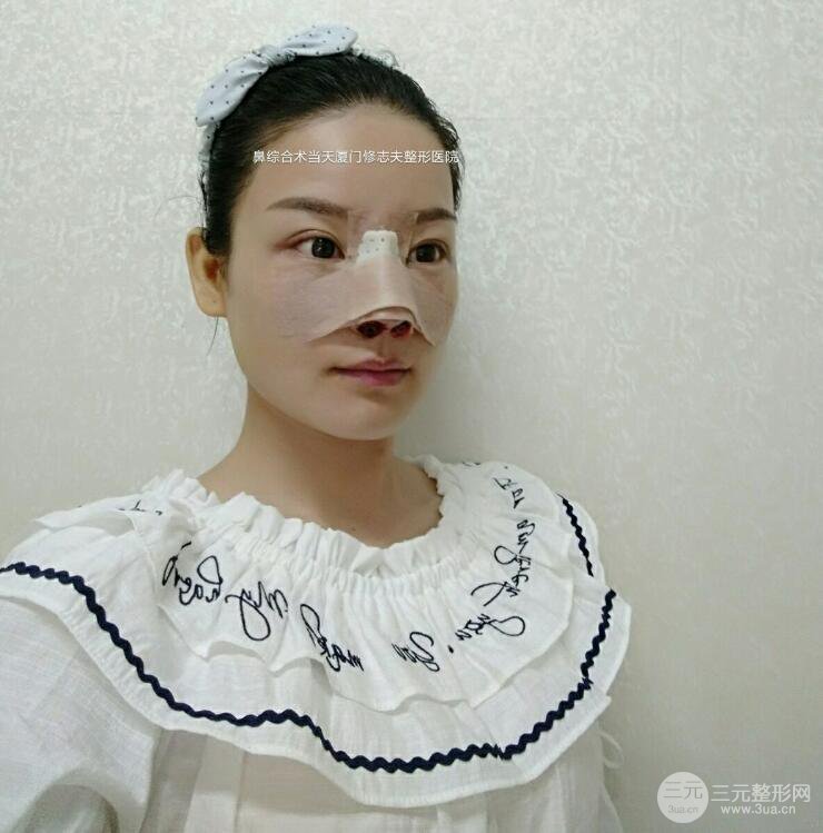 厦门修志夫隆鼻整形前后对比图真人案例恢复小札