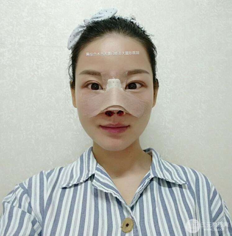 厦门修志夫隆鼻整形前后对比图真人案例恢复小札