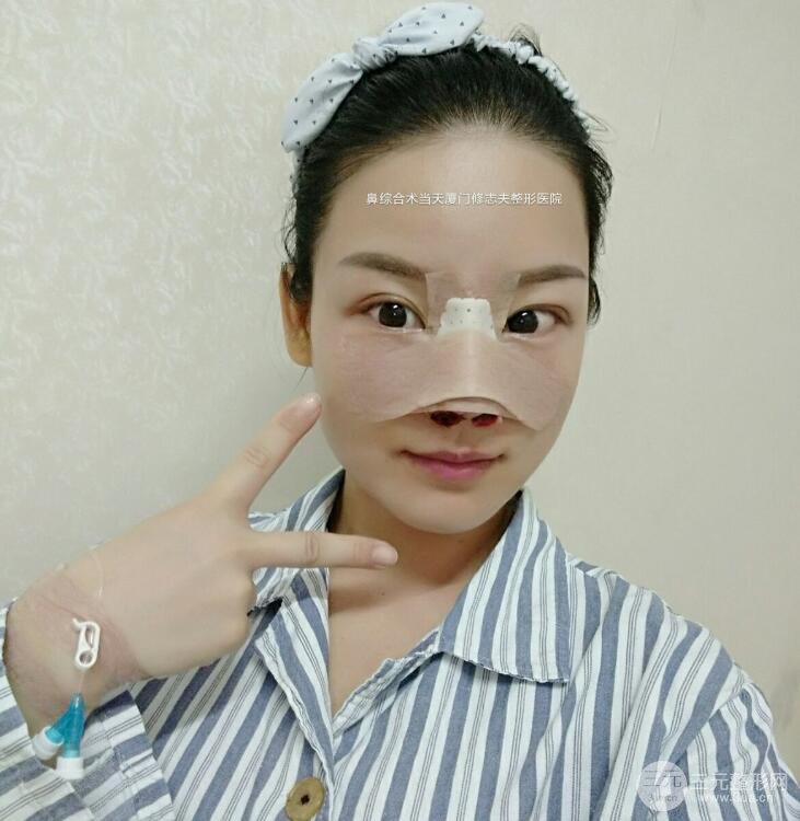 厦门修志夫隆鼻整形前后对比图真人案例恢复小札