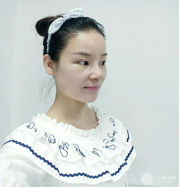 厦门修志夫隆鼻整形前后对比图真人案例恢复小札