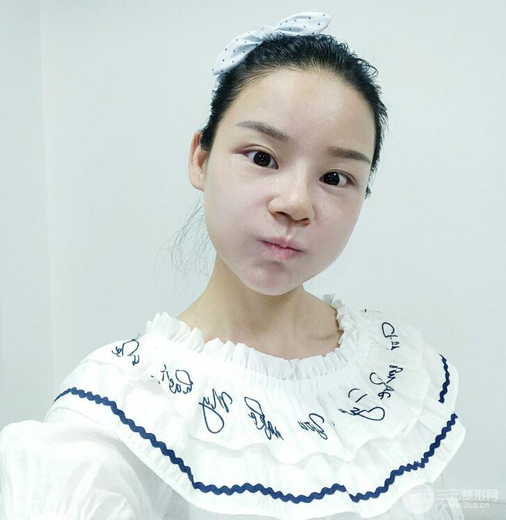 厦门修志夫隆鼻整形前后对比图真人案例恢复小札