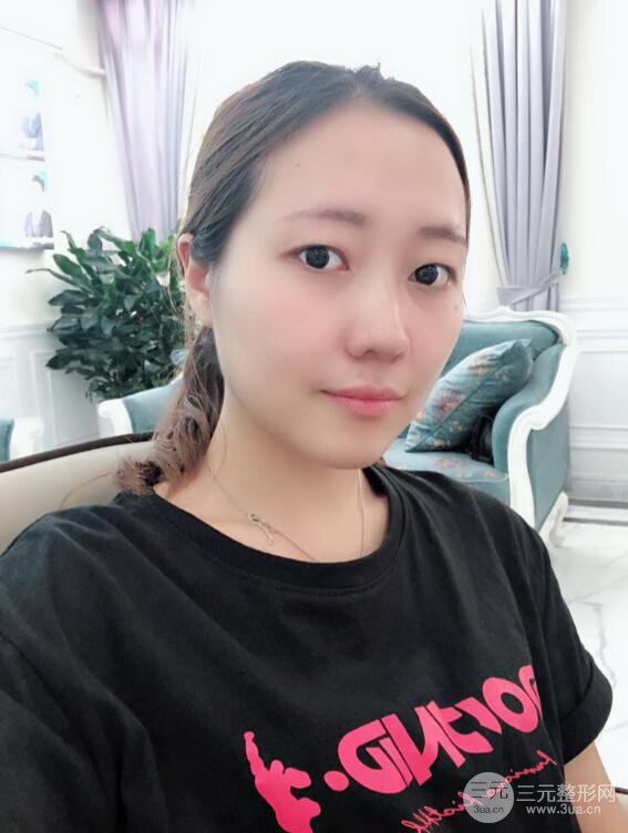 哈医大二院整形科肖志波全切双眼皮前后对比图 真实恢复经历日记