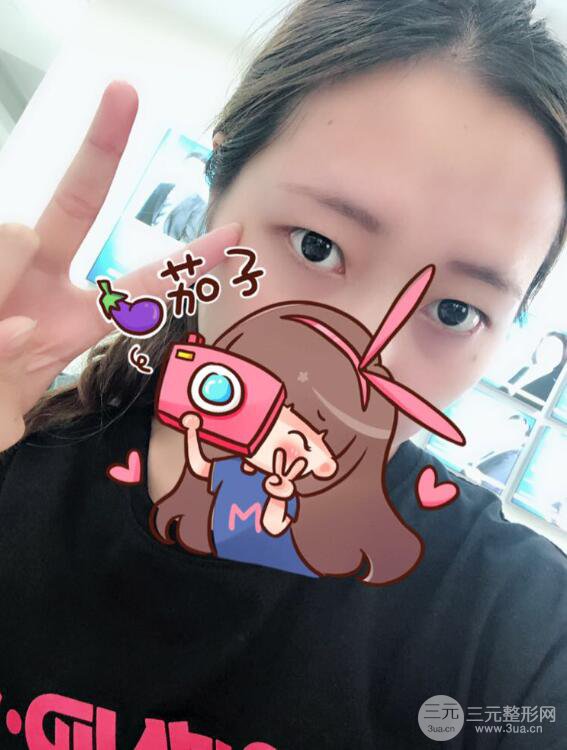 哈医大二院整形科肖志波全切双眼皮前后对比图 真实恢复经历日记