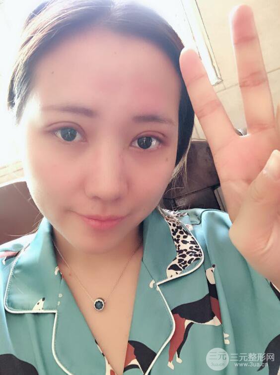 哈医大二院整形科肖志波全切双眼皮前后对比图 真实恢复经历日记