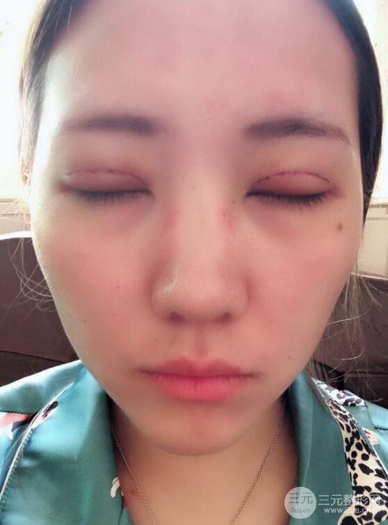 哈医大二院整形科肖志波全切双眼皮前后对比图 真实恢复经历日记