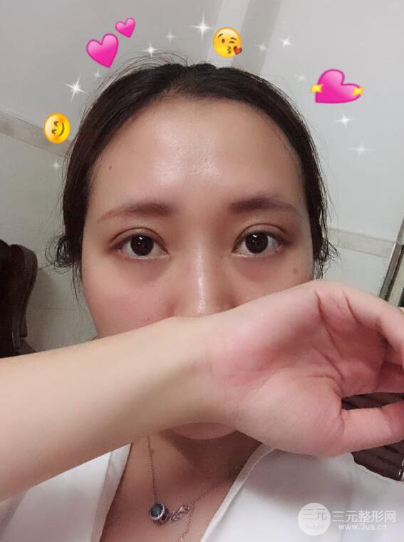 哈医大二院整形科肖志波全切双眼皮前后对比图 真实恢复经历日记