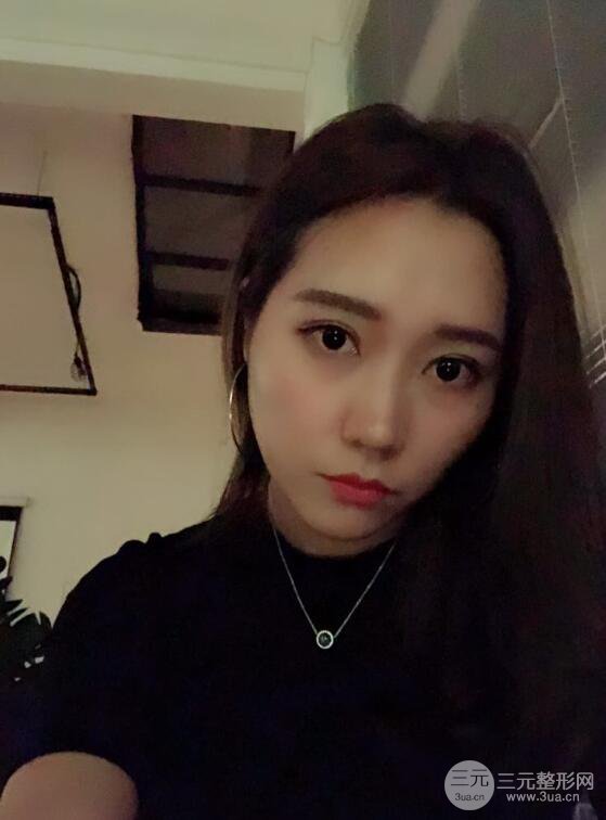 哈医大二院整形科肖志波全切双眼皮前后对比图 真实恢复经历日记