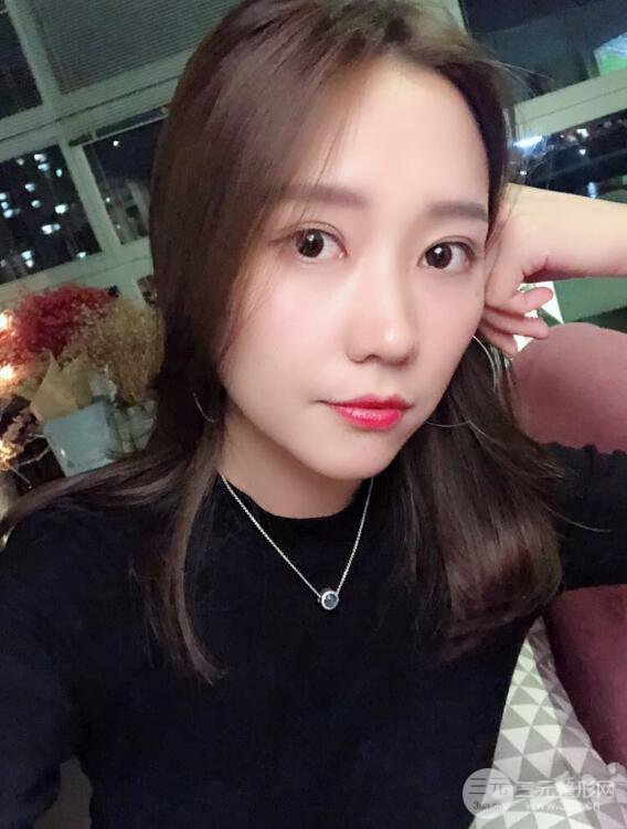 哈医大二院整形科肖志波全切双眼皮前后对比图 真实恢复经历日记