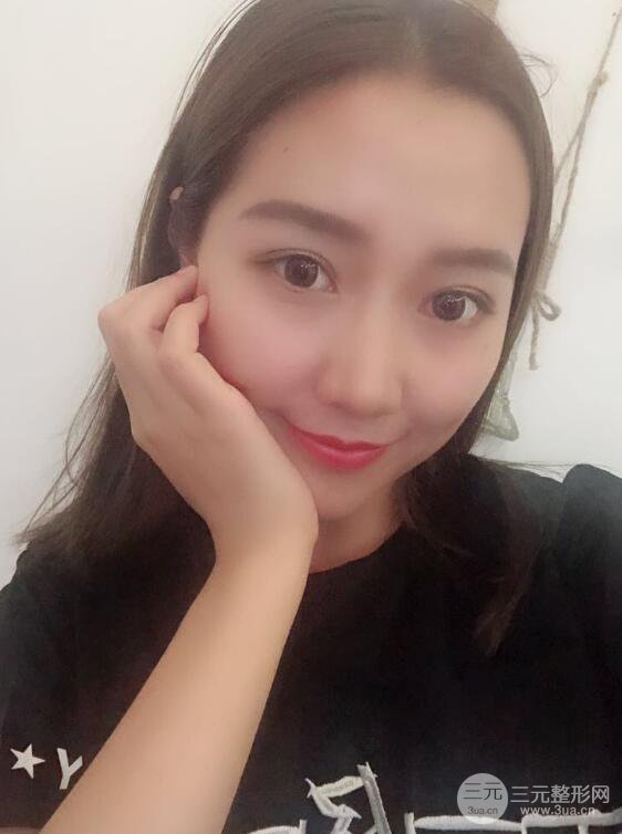 哈医大二院整形科肖志波全切双眼皮前后对比图 真实恢复经历日记