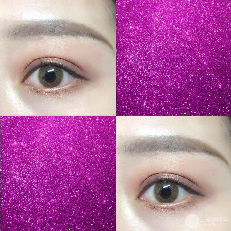 哈医大二院整形科肖志波全切双眼皮前后对比图 真实恢复经历日记