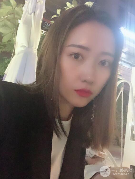 哈医大二院整形科肖志波全切双眼皮前后对比图 真实恢复经历日记