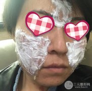 像素激光祛痘坑痘疤多久见？果好使吗？