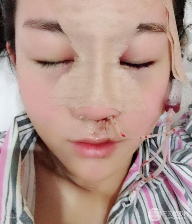 杭州华山连天美高俊明假体隆鼻术前术后对比图 两个月恢复心情