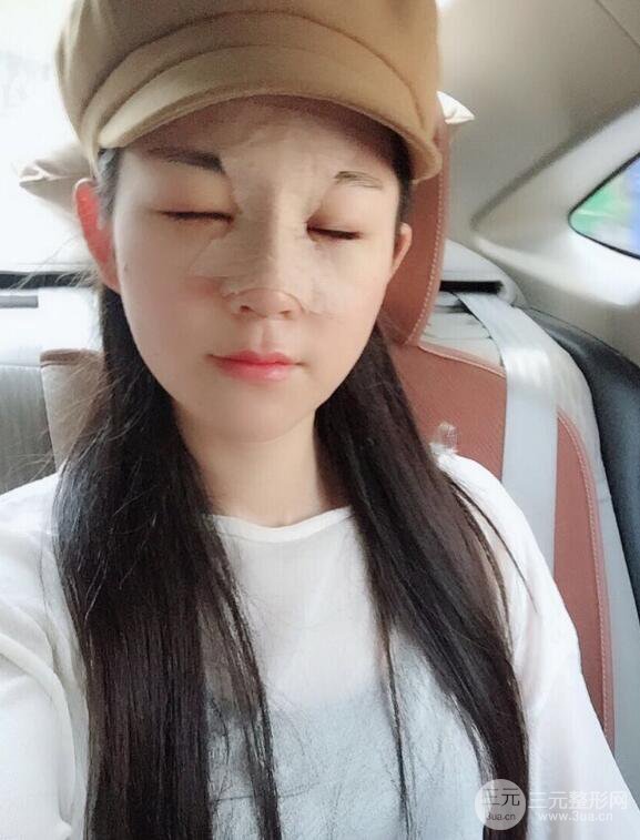 杭州华山连天美高俊明假体隆鼻术前术后对比图 两个月恢复心情