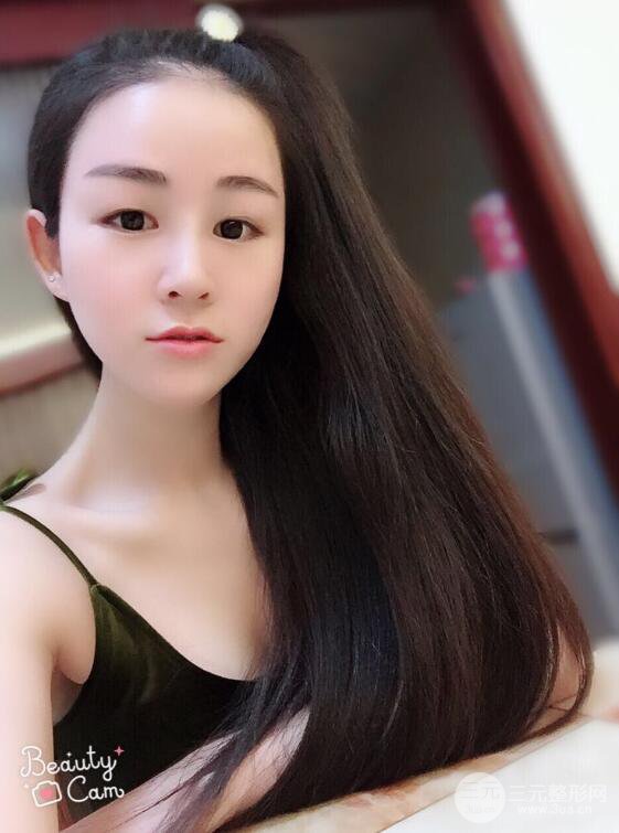 杭州华山连天美高俊明假体隆鼻术前术后对比图 两个月恢复心情