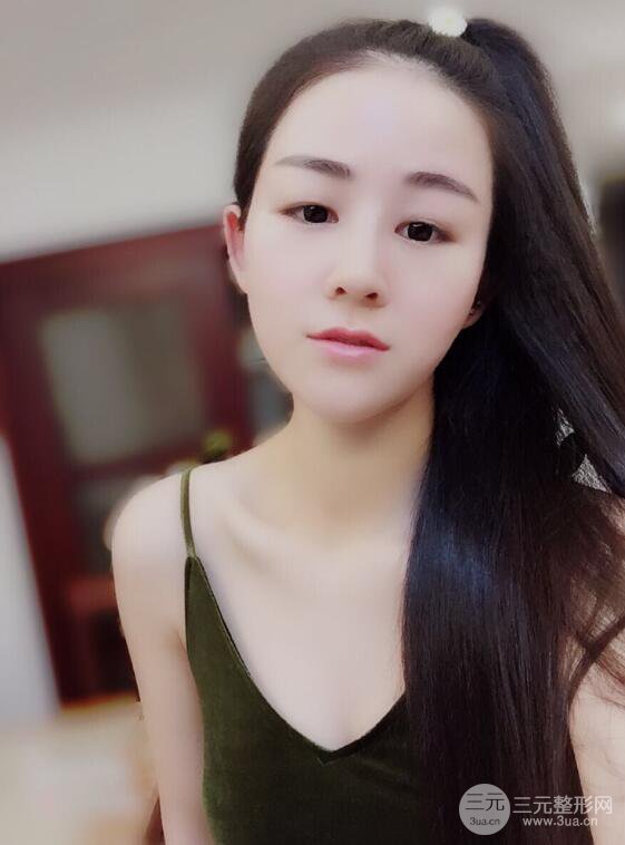 杭州华山连天美高俊明假体隆鼻术前术后对比图 两个月恢复心情