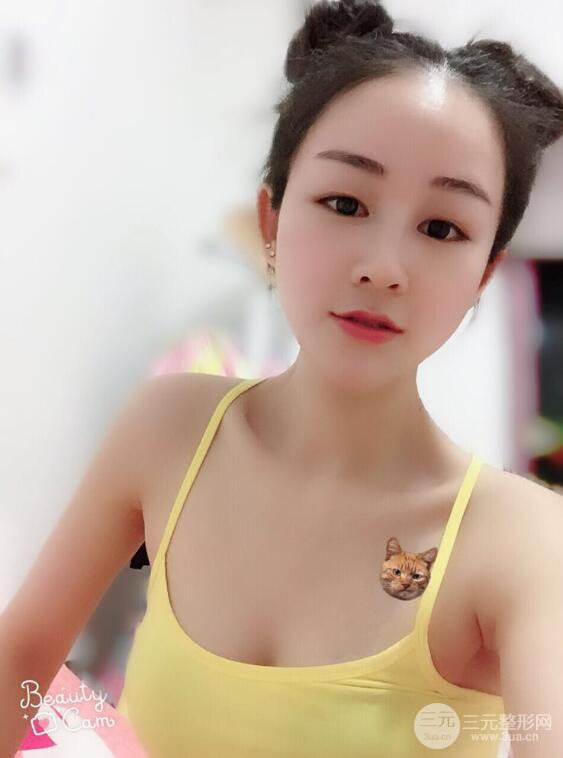 杭州华山连天美高俊明假体隆鼻术前术后对比图 两个月恢复心情